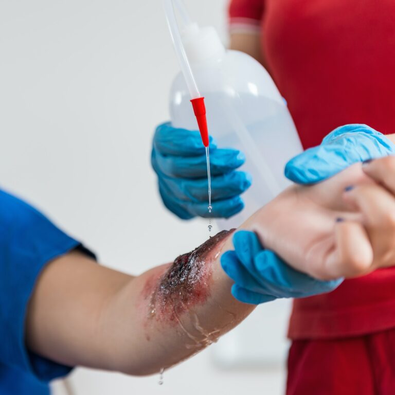 First Aid Training - Burn injury