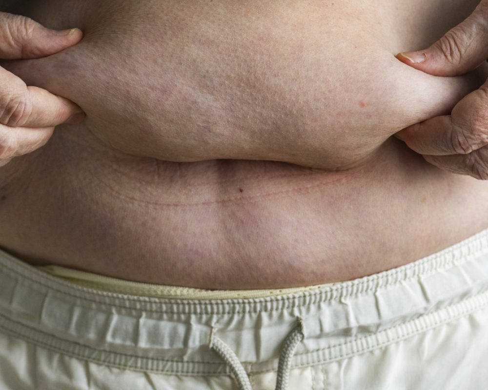 Closeup of obese elderly woman